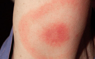 Not Everyone With Lyme Disease Develops A Rash